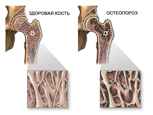 Здоровая костная ткань и с остеопорозом