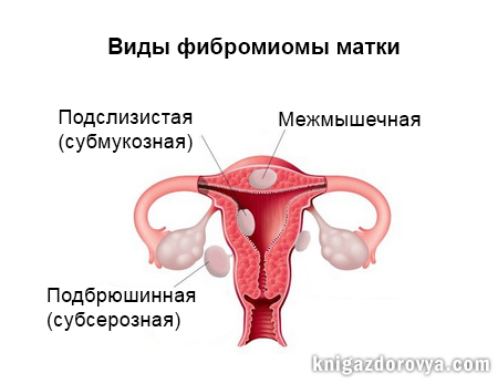 Виды фибромиомы матки